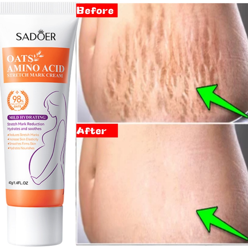 Stretch Marks Permanent Remova - Skincare Oat recension och pris