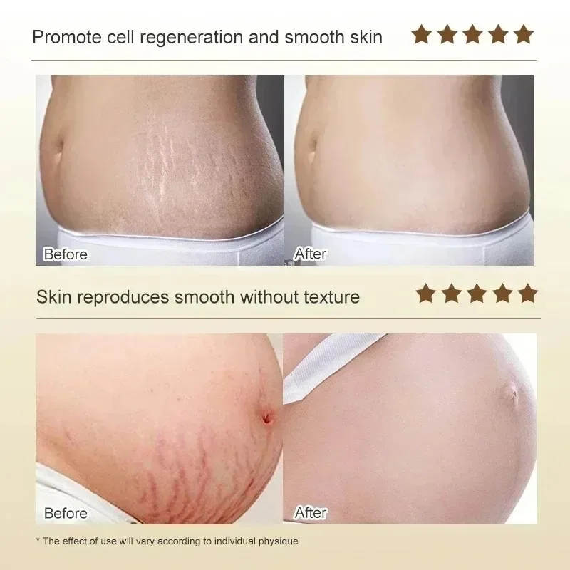 Stretch Marks Permanent Remova - Skincare Oat recension och pris